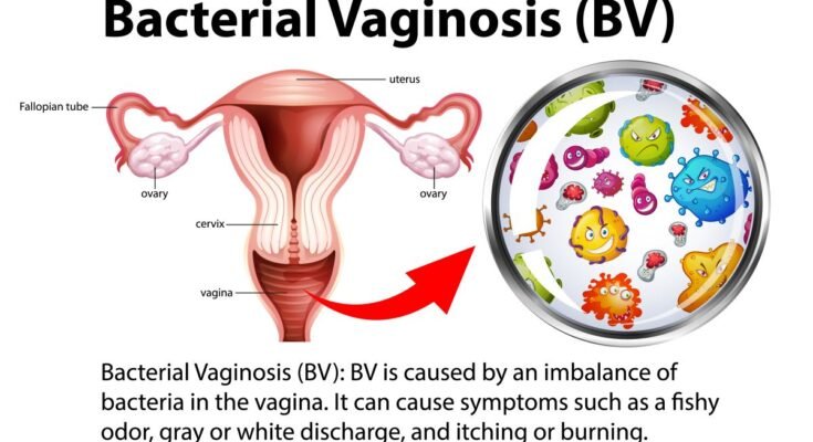 Bacterial Vaginosis and Pregnancy