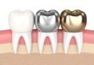 The Lifespan of a Root Canal Without a Crown Revealed