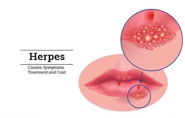 Speed Up Healing Herpes Sores